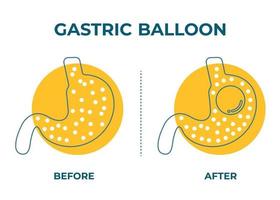 stomaco endoscopia gastrico Palloncino dentro un' stomaco peso perdita chirurgia vettore illustrazione obesità