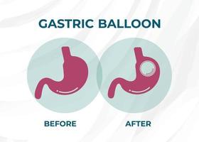 stomaco endoscopia gastrico Palloncino dentro un' stomaco peso perdita chirurgia vettore illustrazione obesità
