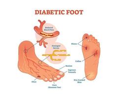 diabetico piede vettore