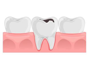 denti con carie nel gomma. dentale anatomia. piatto vettore illustrazione isolato su bianca.