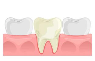 giallo dente nel piatto stile. denti e gomma anatomia. dentale Salute. vettore illustrazione isolato su bianca.