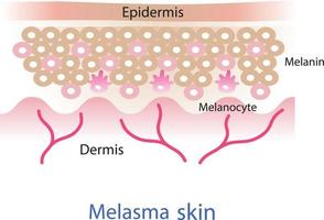 il meccanismo di melasma pelle vettore. bellezza pelle cura concetto illustrazione. vettore