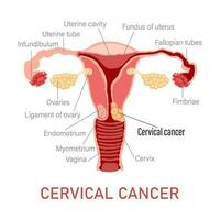 cervicale cancro. malattie di il femmina riproduttore sistema. ginecologia. medico concetto. Infografica striscione. vettore