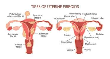 tipi di uterino fibromi nel donne. fibromi. malattie di il femmina riproduttore sistema. salutare e malsano utero. ginecologia. medico concetto. Infografica striscione. vettore