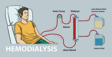 illustrazione di emodialisi diagramma vettore