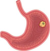 stomaco cancro vettore illustrazione isolato su bianca sfondo