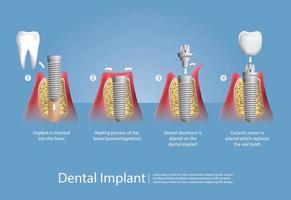 denti umani e set di impianti dentali vettore