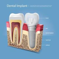 illustrazione di vettore di denti umani e impianto dentale