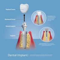 illustrazione di vettore di denti umani e impianto dentale
