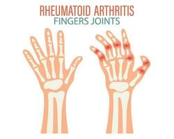 reumatoide artrite. osteoartrite di il articolazioni di il dita e le dita dei piedi. medico concetto. Infografica manifesto, striscione, vettore