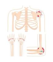 lesione dolorosa di artrite vettore