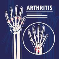mani di ossa di artrite vettore