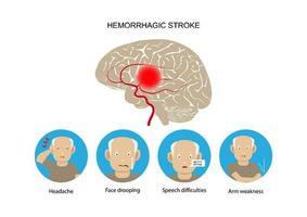 emorragico ictus e avvertimento segni e sintomi. vettore