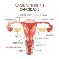 vaginale fungine infezione. candidosi. infografica di ginecologico malattie. ginecologia. medicinale. Infografica striscione, vettore. vettore