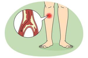 persona soffrire a partire dal tampone malattia nel gambe vettore