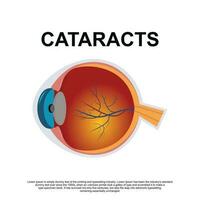 cataratta vettore illustrazione nel piatto stile