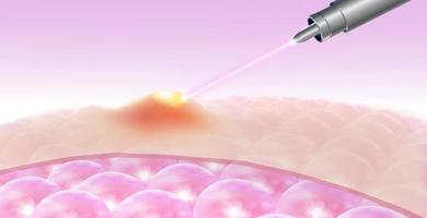 trattamento dell'acne laser vettore