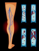Coagulo di sangue nella gamba umana vettore