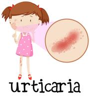 Giovane ragazza con orticaria vettore