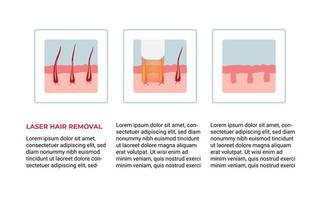 concetto di depilazione laser vettore