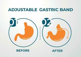 illustrazione di regolabile gastrico gruppo musicale escogitare peso perdita chirurgia vettore