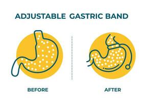 illustrazione di regolabile gastrico gruppo musicale escogitare peso perdita chirurgia vettore