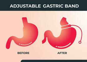 illustrazione di regolabile gastrico gruppo musicale escogitare peso perdita chirurgia vettore