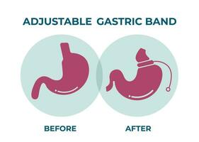 illustrazione di regolabile gastrico gruppo musicale escogitare peso perdita chirurgia vettore