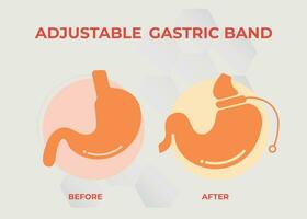 illustrazione di regolabile gastrico gruppo musicale escogitare peso perdita chirurgia vettore