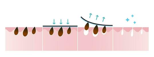 comedone rimozione processi vettore illustrazione isolato su bianca sfondo. attraversare sezione di comedone poro striscia trattamento, fare domanda a, sbucciare spento, disostruzione e serrare pori. prima e dopo concetto.