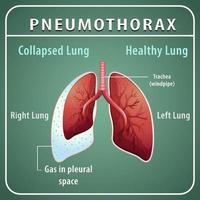 diagramma pneumotorace con polmone collassato e polmone sano vettore