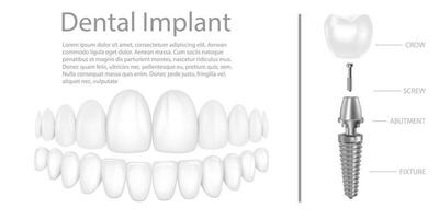 dentale impiantare struttura medico pittorico educativo Infografica manifesto con molare sostituzione fine salutare utensili Modelli vettore illustrazione.