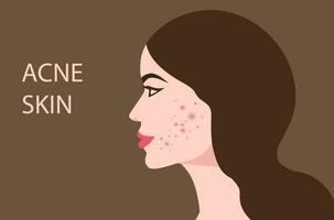 donna viso con pelle acne, brufoli, punti neri vettore illustrazione.