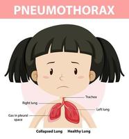 diagramma di pneumotorace dell'anatomia umana vettore