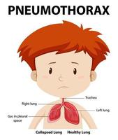 diagramma di pneumotorace dell'anatomia umana vettore