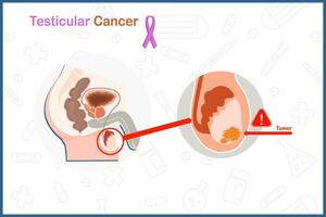 piatto medico vettore nel testicolare cancro concetto. un' maschio anatomia di testicolare cancro illustrazione isolato su bianca sfondo.