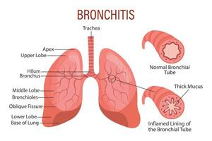 bronchite, un' polmone patologia. assistenza sanitaria. medico Infografica striscione, illustrazione, vettore