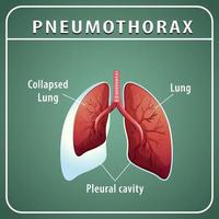 diagramma pneumotorace con polmone collassato e polmone normale vettore