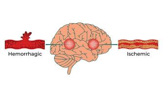 emorragico ischemico scienza design vettore illustrazione diagramma