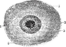 maligno pustola o antrace, Vintage ▾ incisione. vettore