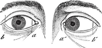 esotropia di il sinistra occhio, Vintage ▾ incisione. vettore