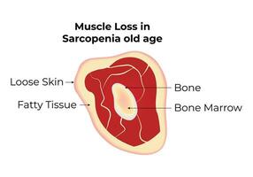 muscolo perdita nel sarcopenia vecchio età scienza design vettore illustrazione