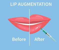 labbro aumento. prima e dopo labbro riempitivo iniezioni. ialuronico acido iniezioni. vettore illustrazione nel piatto stile