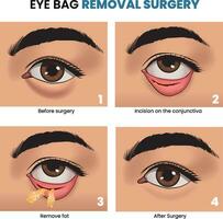 illustrazione di occhio Borsa rimozione chirurgia vettore