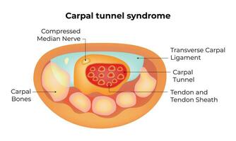 carpale tunnel sindrome scienza design vettore illustrazione diagramma