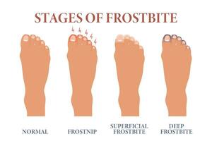 congelato le dita dei piedi. stadi di congelamento di dita. assistenza sanitaria e medicinale. vettore