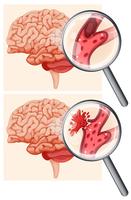 Cervello umano ed ictus emorragico vettore