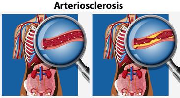 Anatomia umana con arteriosclerosi vettore