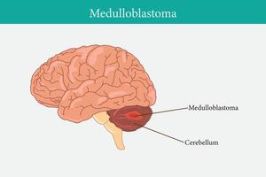 cervello cancro concetto. maligno tumore si sviluppa nel il umano cervello. cancro cellula struttura. piatto vettore illustrazione. eps 10