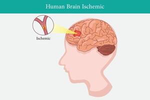 umano anatomia malattia ischemico ictus vettore illustrazione su bianca sfondo. eps 10